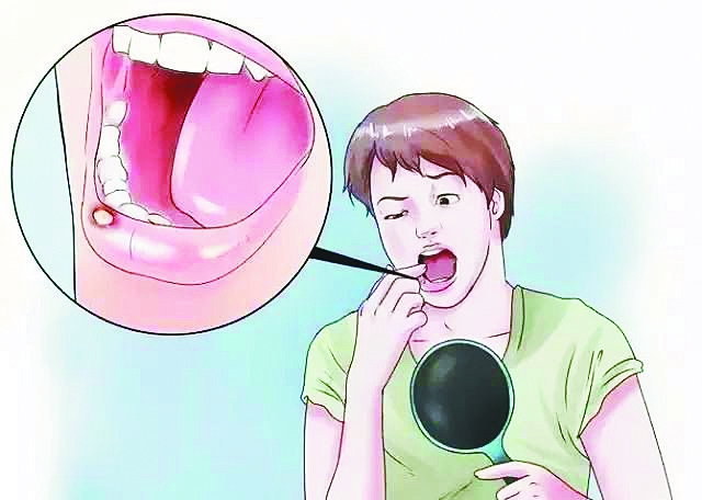 口腔潰瘍不是只需要補(bǔ)充維生素C，它們也是必不可少